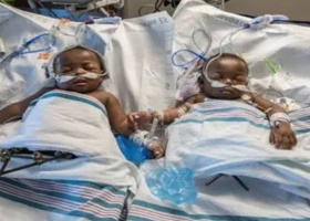 Photo of Conjoined twins die after delivery at LASUTH