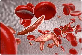 Photo of World Sickle Cell Day: 50 million Nigerians are carriers of the anaemia
