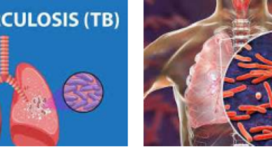 Photo of Nigeria among nations falling short of 2025 End TB targets – WHO warns 